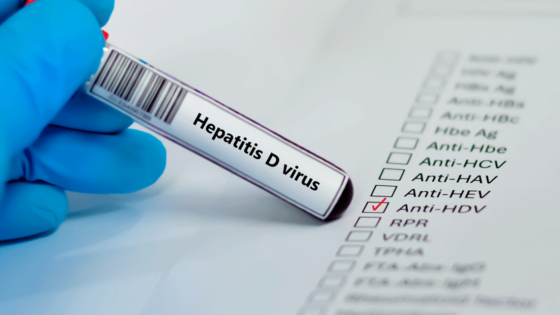 Dieses Bild zeigt einen Labortest für das Hepatitis-D-Virus (HDV). Eine behandschuhte Hand hält ein Reagenzglas mit der Aufschrift „Hepatitis D Virus“, und im Hintergrund ist eine Checkliste mit verschiedenen hepatitisbezogenen Markern zu sehen, darunter „Anti-HDV“, das angekreuzt ist.