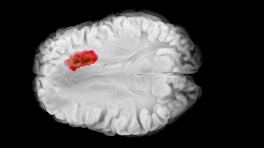 Dieses Bild zeigt eine medizinische Darstellung eines Gehirns, vermutlich eine MRT- oder CT-Aufnahme, bei der ein Bereich im Gehirn farblich hervorgehoben ist. Der rot markierte Bereich könnte auf eine Anomalie hinweisen, wie beispielsweise eine Entzündung, einen Tumor, eine Blutung oder eine andere pathologische Veränderung.