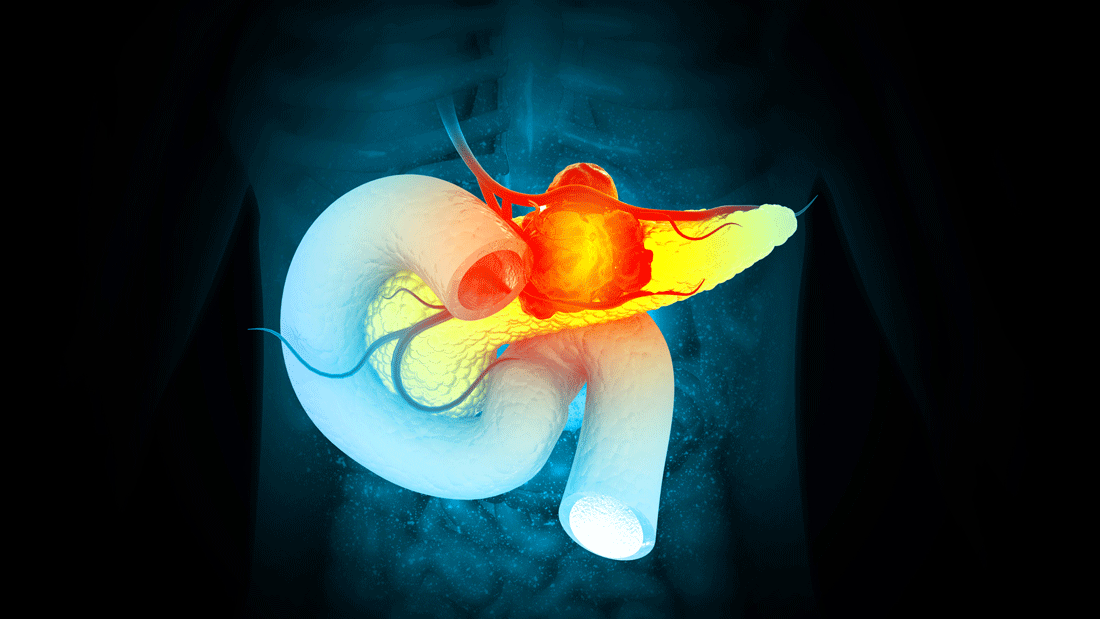 3D-Darstellung des Oberbauchs mit hervorgehobener Bauchspeicheldrüse; ein rötlich markierter Bereich deutet auf Entzündung oder Tumor hin. Sichtbar sind auch Zwölffingerdarm und umliegende Gefäße.
