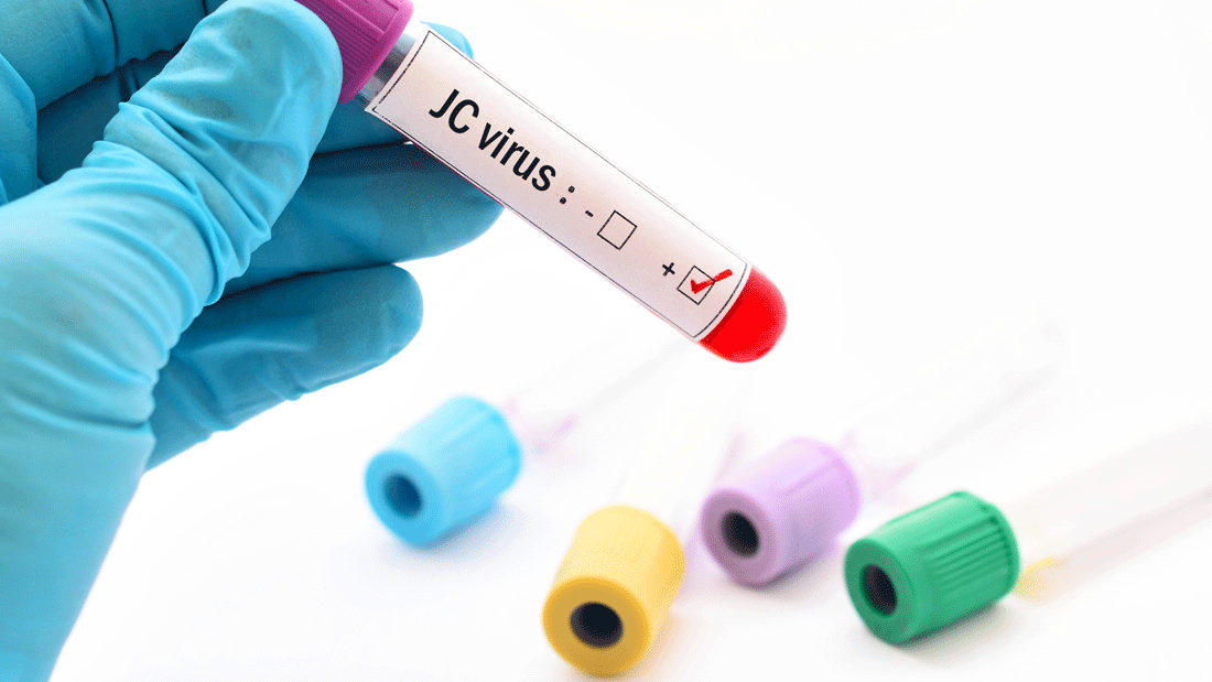 Blau behandschuhte Hand hält ein Blutröhrchen „JC virus“ mit positiv markiertem Ergebnis; weitere Probenröhrchen liegen unscharf im Hintergrund. 