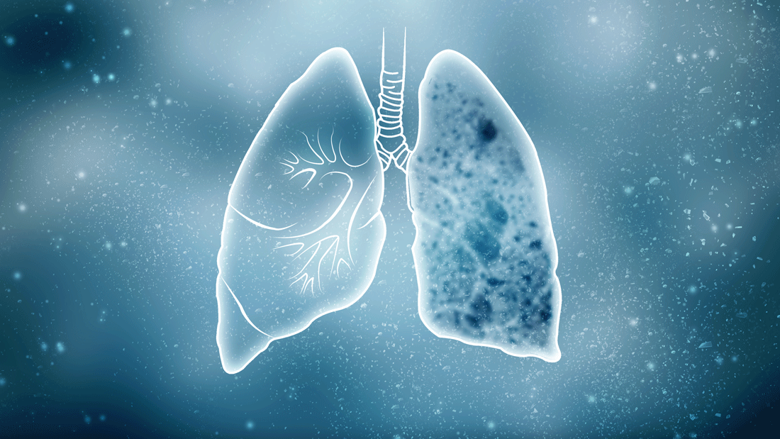 Dieses Bild zeigt eine stilisierte Darstellung menschlicher Lungen, wobei eine Lunge Anzeichen von Schäden oder Erkrankungen aufweist.