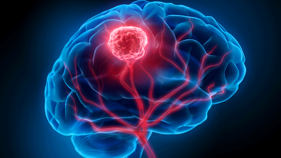 Dieses Bild zeigt eine schematische Darstellung des menschlichen Gehirns mit einem hervorgehobenen Bereich, der möglicherweise auf eine Anomalie wie einen Tumor hinweist. Die roten Linien symbolisieren Blutgefäße, die den betroffenen Bereich versorgen. 