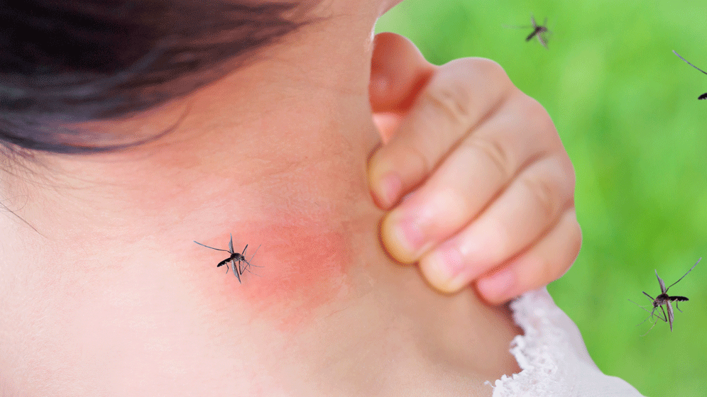 AdobeStock_221862768.gif Mückenstiche