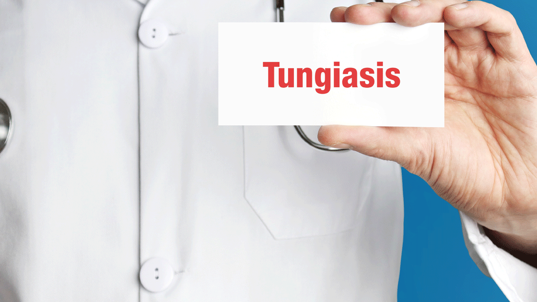 Person im weißen Arztkittel mit Stethoskop hält eine Karte mit dem Wort „Tungiasis“ vor blauem Hintergrund.