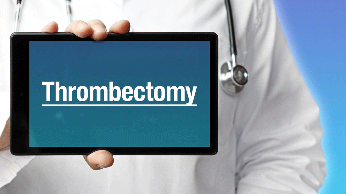 Dieses Bild zeigt eine medizinische Fachkraft, die ein Tablet hält, auf dem das Wort „Thrombectomy“ angezeigt wird. 