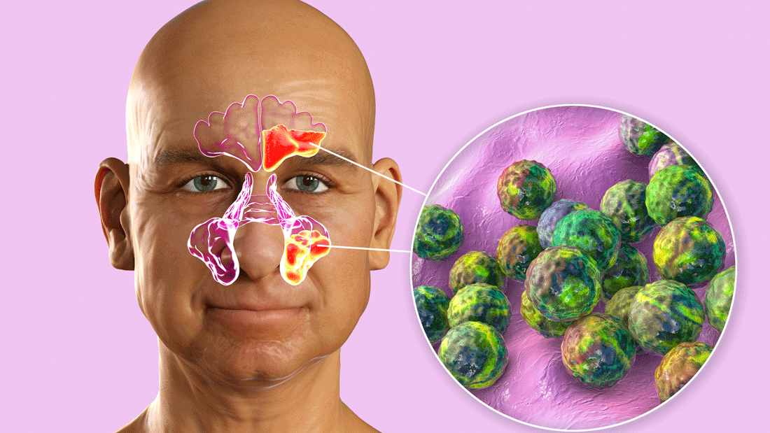 Das Bild zeigt eine medizinische Darstellung, die auf eine Infektion oder Erkrankung hinweist. Der Fokus liegt auf einer Vergrößerung von Bakterien oder Zellen, die möglicherweise eine Krankheit oder Infektion symbolisieren.