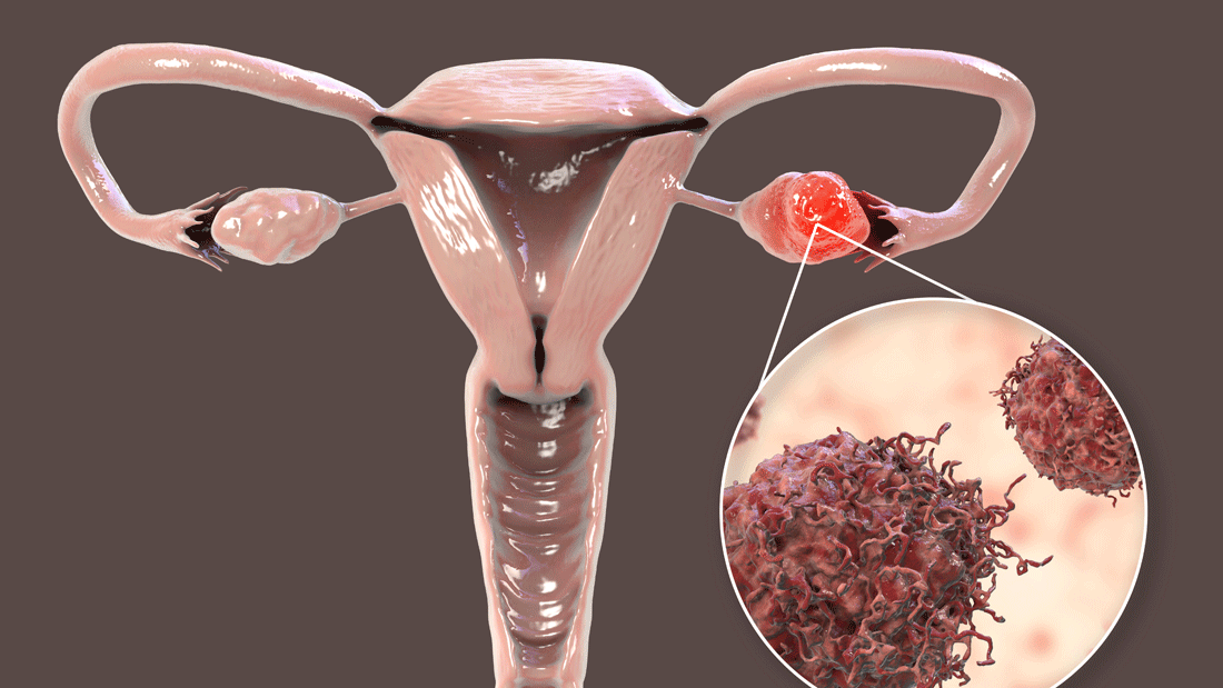 Dieses Bild zeigt eine anatomische Darstellung der weiblichen Fortpflanzungsorgane, einschließlich der Gebärmutter, der Eileiter und der Eierstöcke. Der Fokus liegt auf einem Eierstock, der Krebs zeigt. Die vergrößerte Ansicht hebt die Struktur der betroffenen Zellen hervor. 