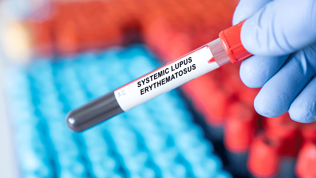 Dieses Bild zeigt eine Blutprobe mit der Beschriftung „Systemischer Lupus erythematodes“.