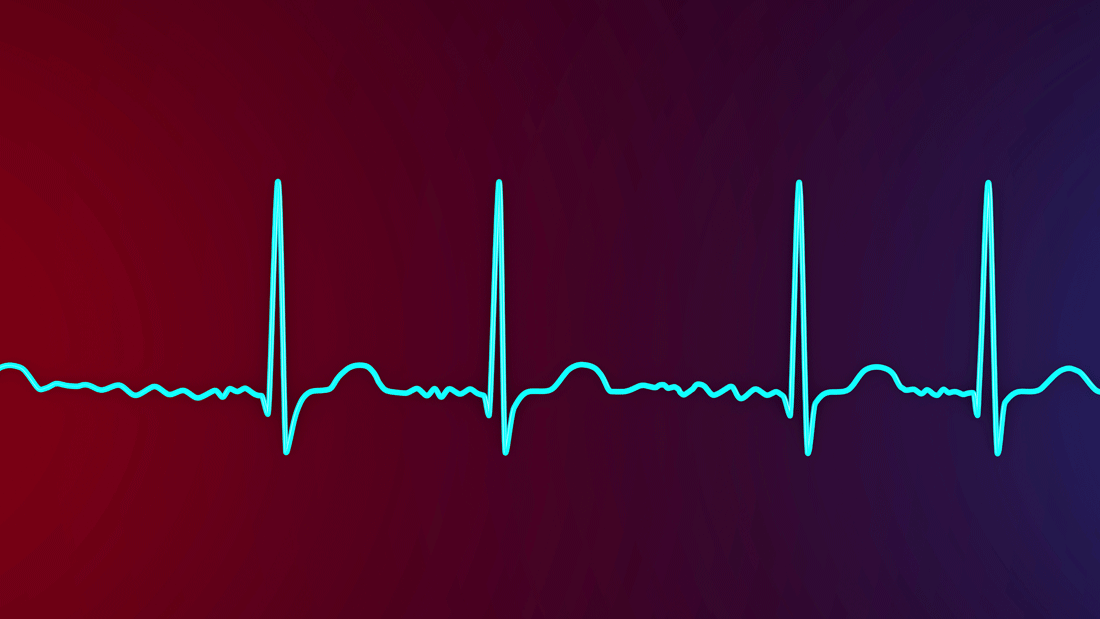 Dieses Bild zeigt eine Elektrokardiogramm-Kurve, die die elektrische Aktivität des Herzens darstellt. Es wird ein Vorhofflimmern angezeigt.