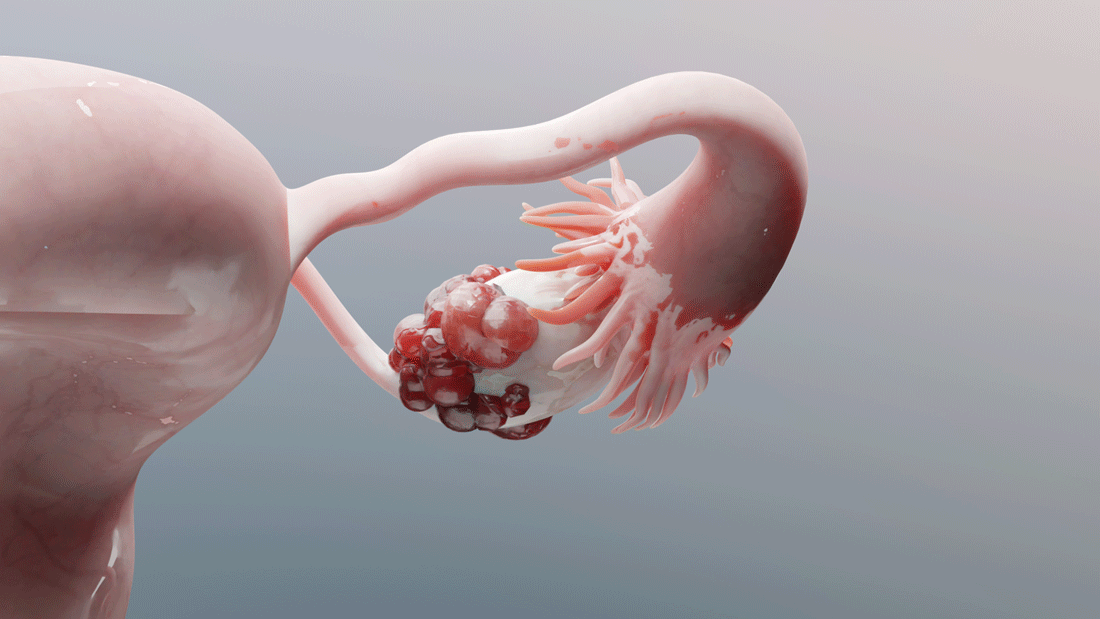 Dieses Bild zeigt eine medizinische Illustration des weiblichen Fortpflanzungssystems, insbesondere des Eierstocks und des Eileiters. Der Eierstock scheint abnorme Wucherungen oder Zysten aufzuweisen, was auf Erkrankungen wie Tumoren hinweisen könnte. Der Eileiter ist ebenfalls sichtbar und verbindet den Eierstock mit der Gebärmutter.