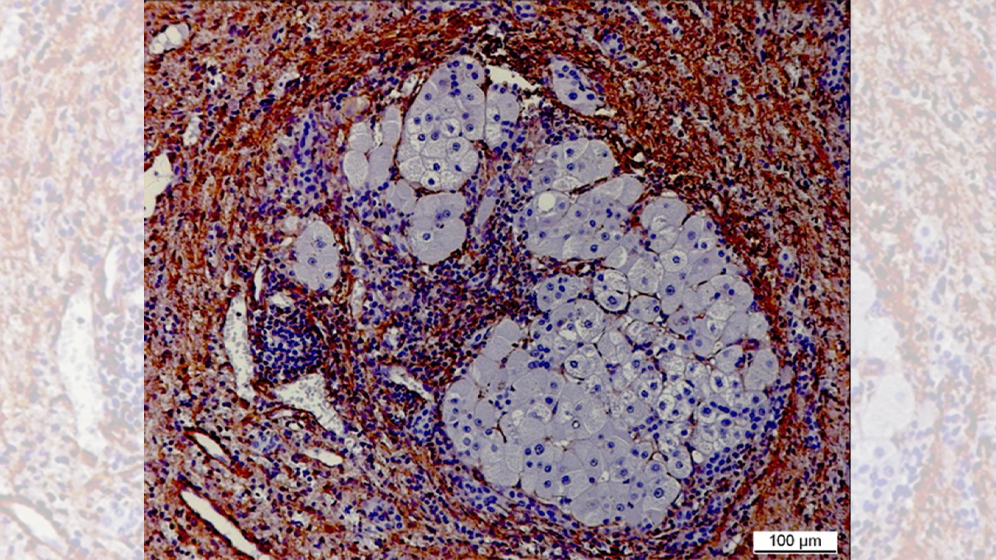 Aktivierte Fibroblasten und Entzündung 