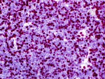 Mantelzelllymphom_Ki67_hoch_400px_UKSH_04032016.jpg Mantelzelllymphom Ki67 hoch