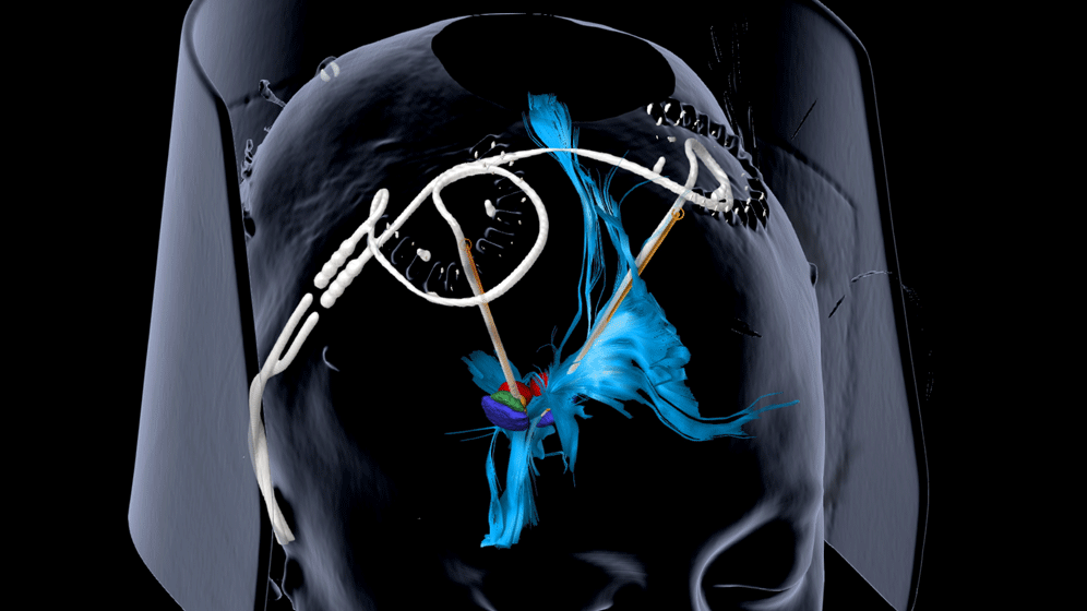 Tiefe Hirnstimulation