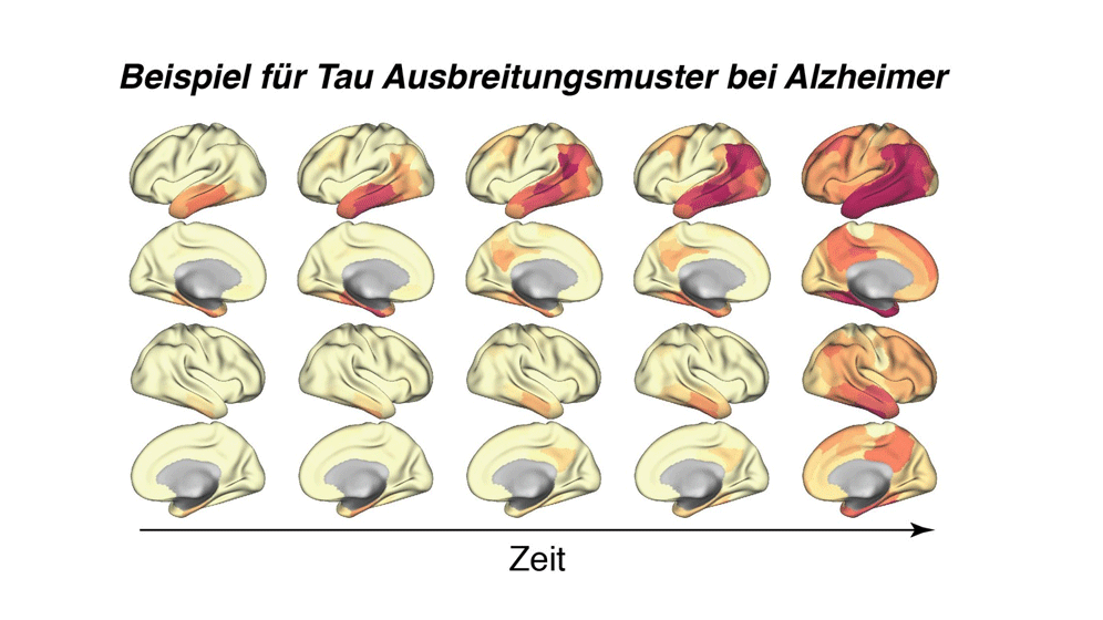 Alzheimer-Demenz