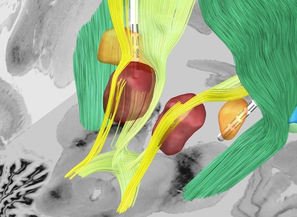 Zielregion der Stimulation