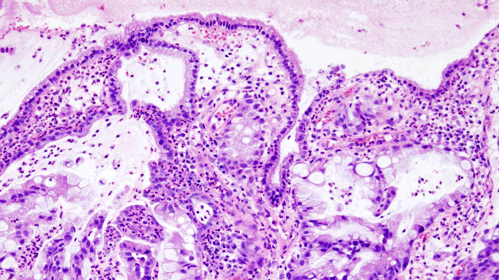 Endocervical_adenocarcinoma__1_.gif Zervixkarzinom-Screening