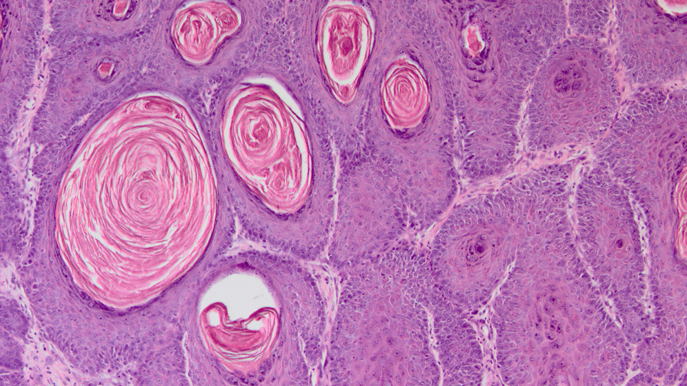 Humane Papillomviren