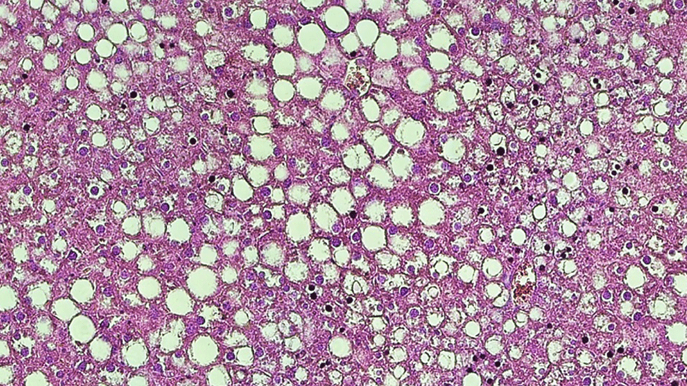 Liver-steatosis-_3_.gif Innere Uhr