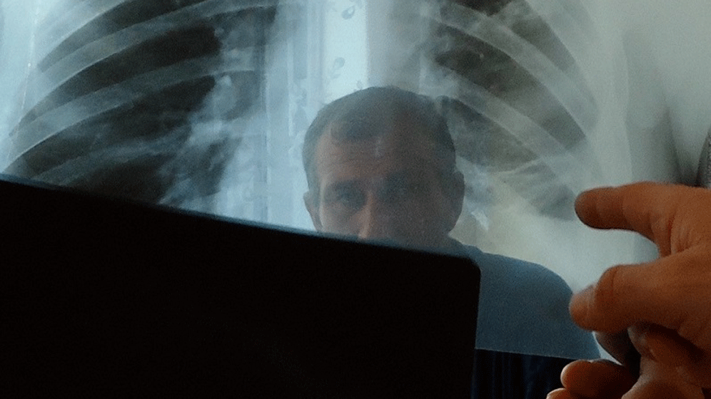 Lunge_800.gif Tuberkulose