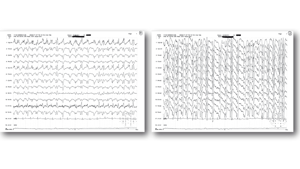 Status epilepticus (klinisch fokal) Fallbeispiel