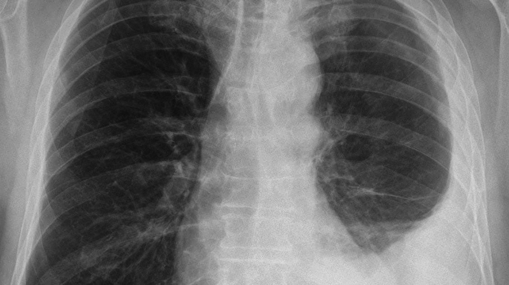Pleural Mesothelioma