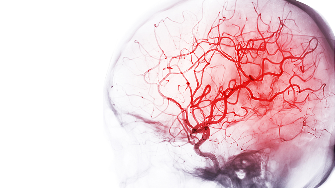 Darstellung der Hirngefäße