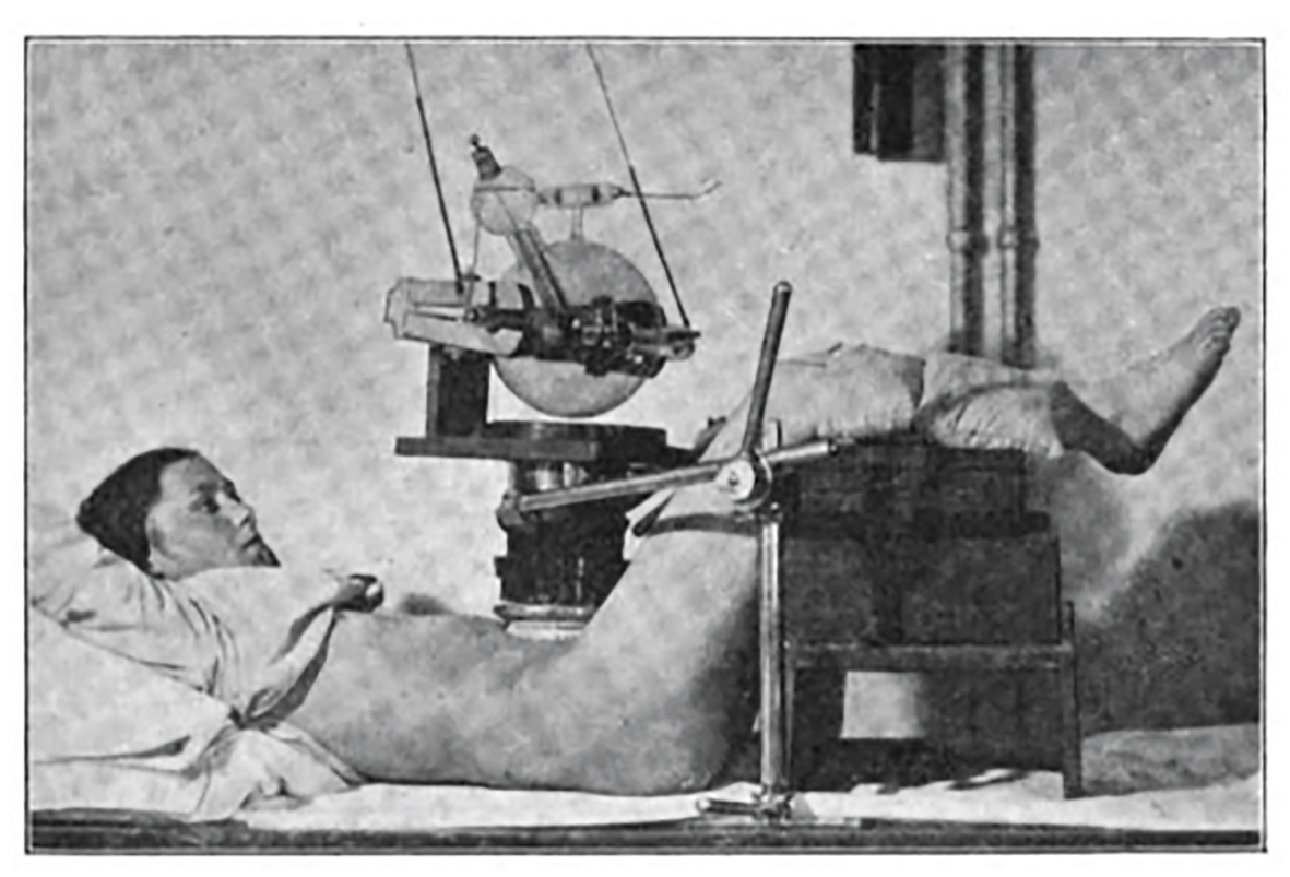 Historisches Foto der diagnostischen Verwendung einer wassergekühlten Röntgenröhre von C. H. F. Müller, Aufnahme der Lendenwirbelsäule