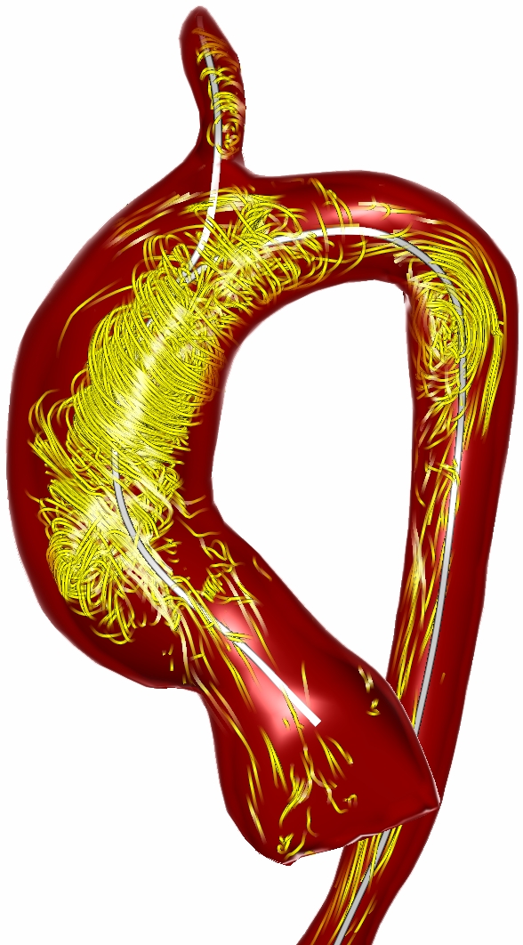 Verwirbelungen des Blutflusses