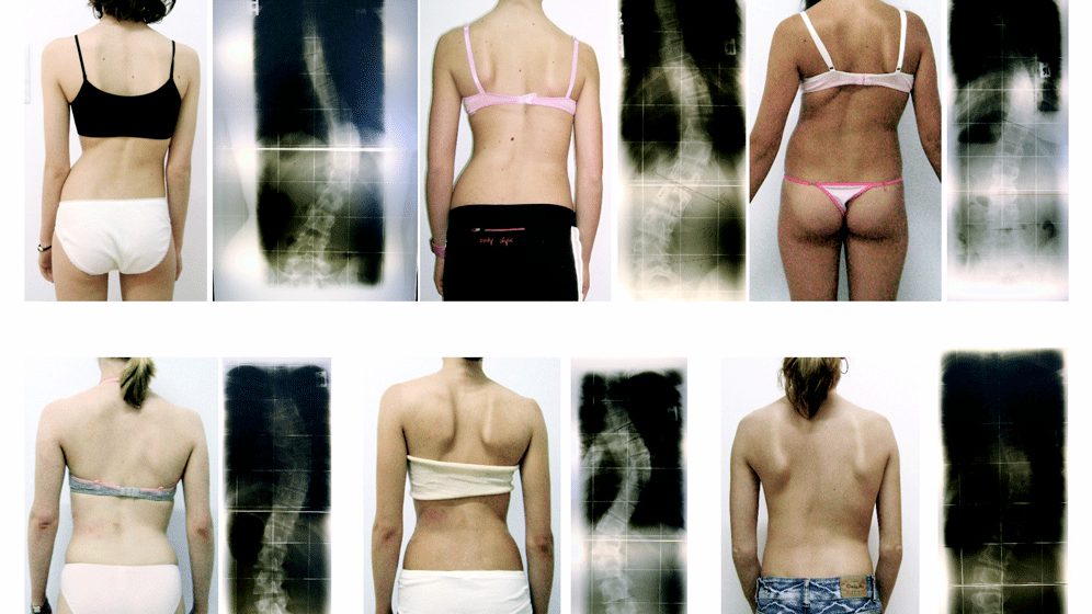 Different_scoliosis_patterns_.gif Skoliose