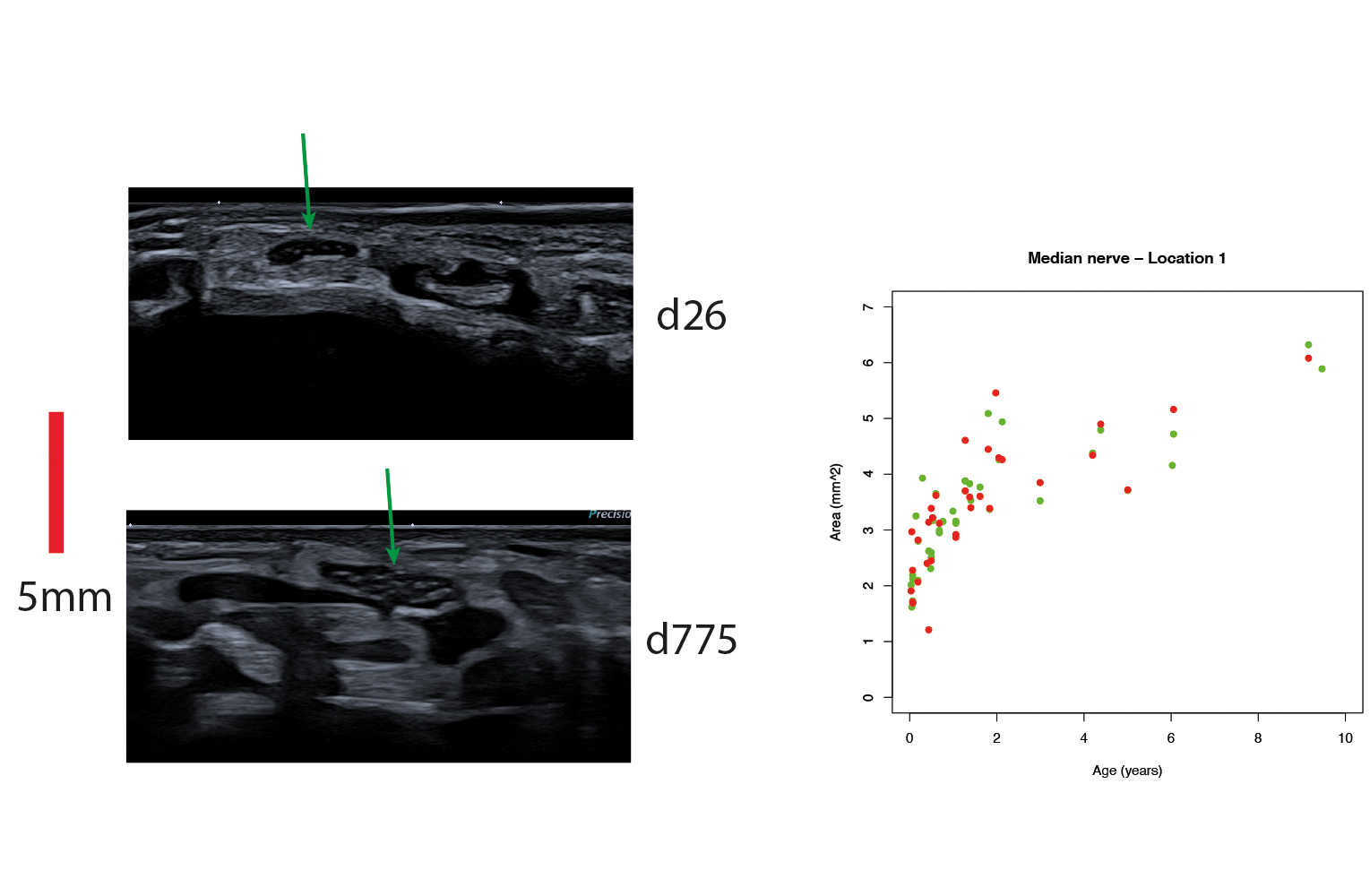 Korrelation zwischen Alter und Durchmesser des Nervus medianus
