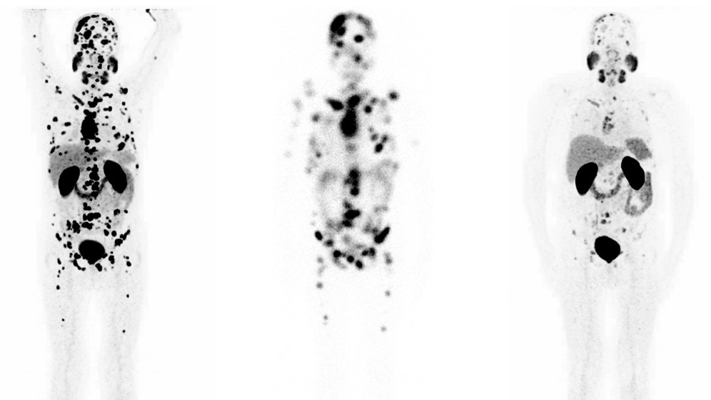Ezziddin-Prostatakrebs-Beispiel.gif Prostatakrebs