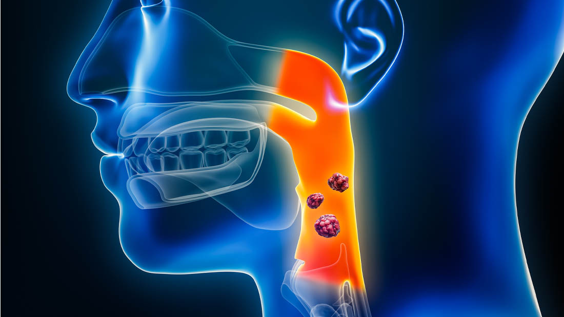 Symbolbild von Kopf-Hals-Tumoren