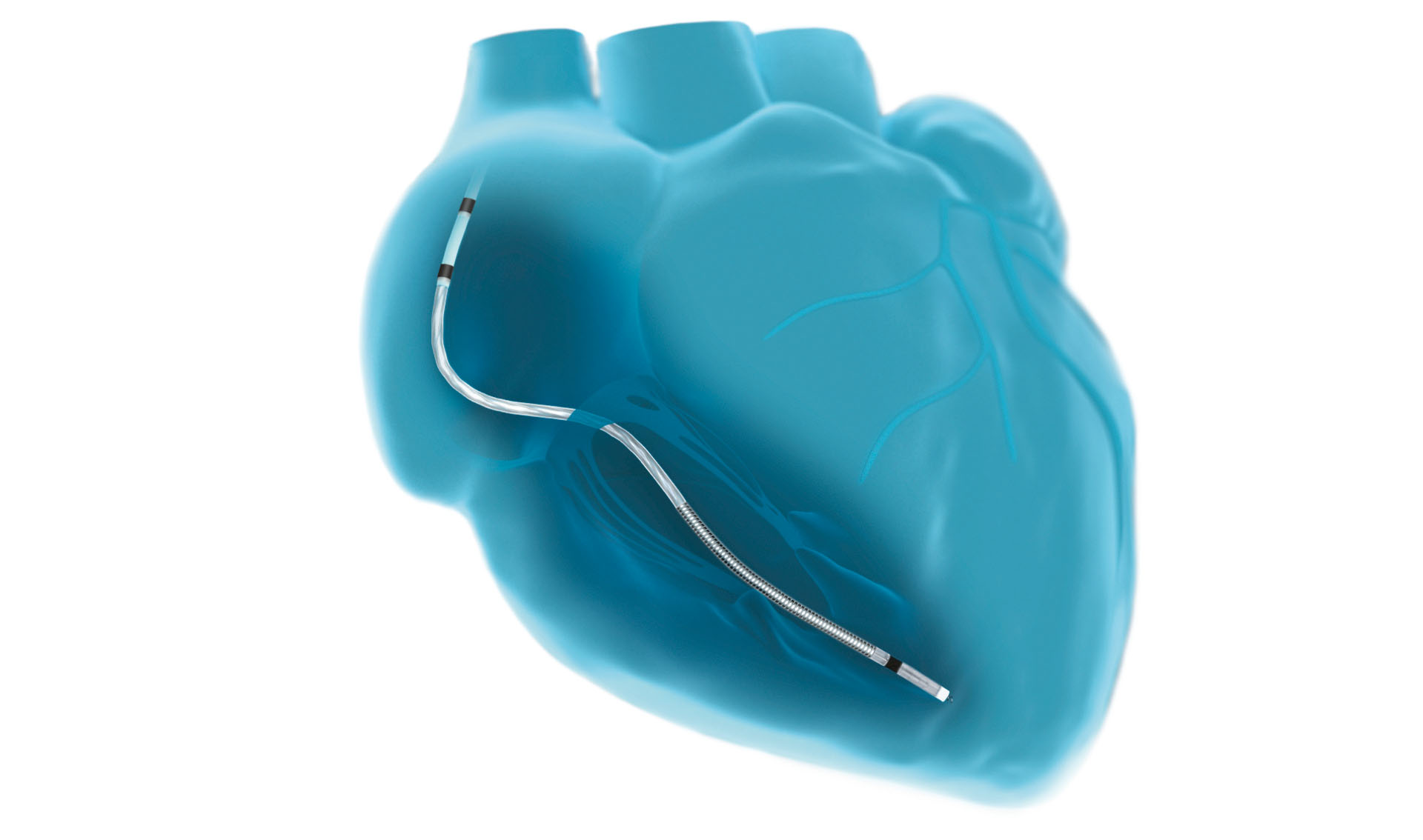 Implantierte Plexa S DX Elektrode
