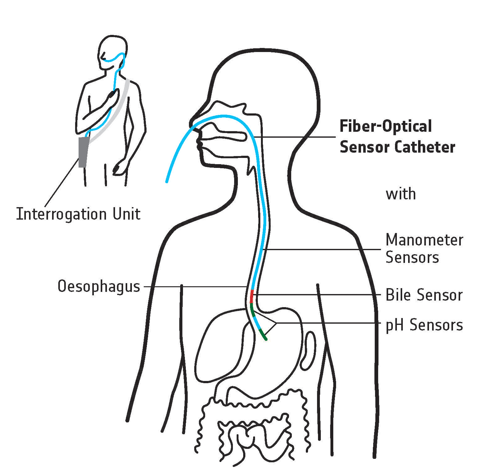 Katheter zur Untersuchung der Speiseröhre 