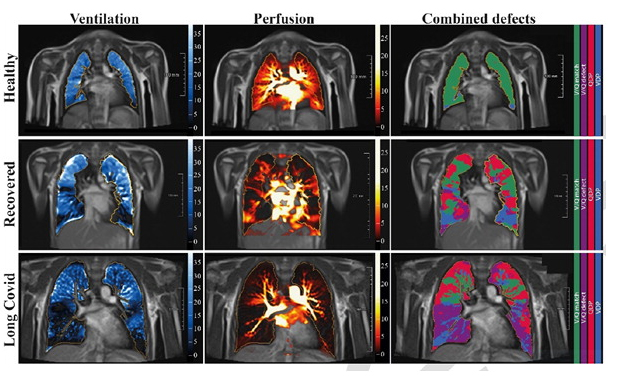 Frei atmende phasenaufgelöste funktionelle Niederfeld-MRT der Lunge bei 0,55 T
