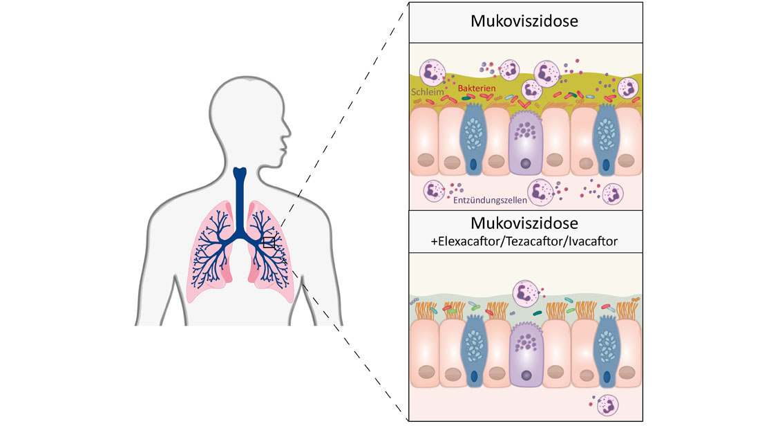 Dreifachtherapie mit den Wirkstoffen Elexacaftor, Tezacaftor und Ivacaftor
