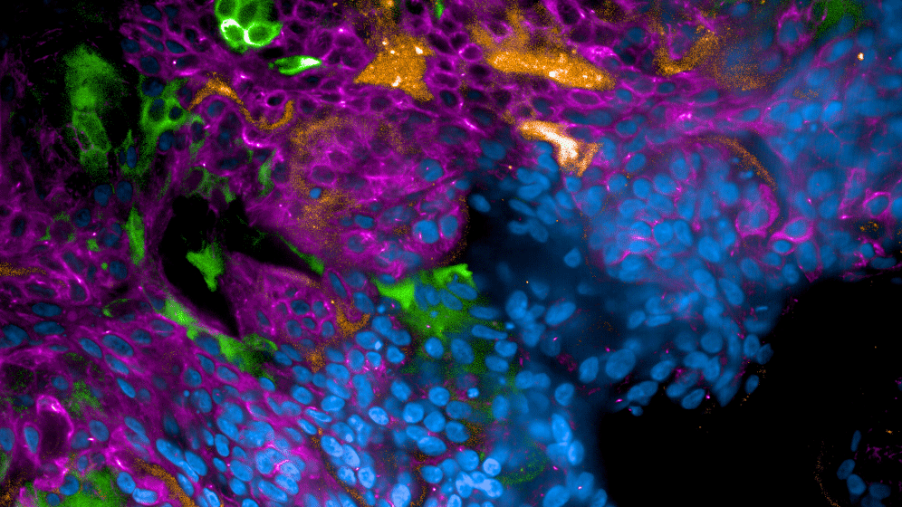 SARS-CoV-2-infiziertes Lungengewebes