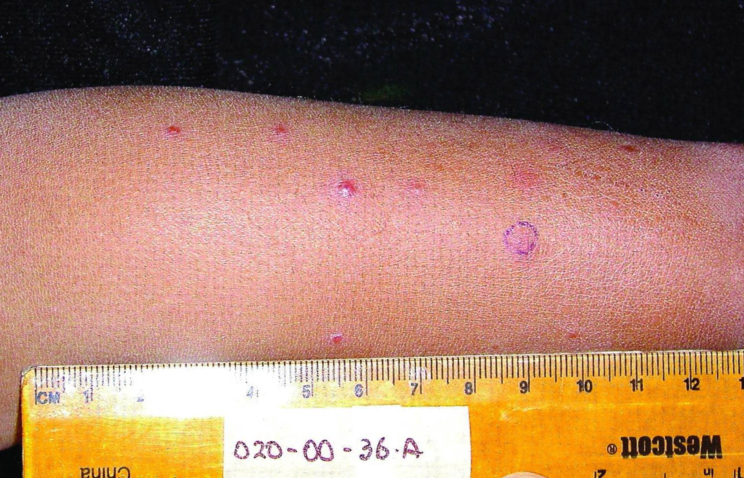 Peruanische_Warzen.jpg Bild von Verruga peruana bei einem 3-jährigen Jungen.