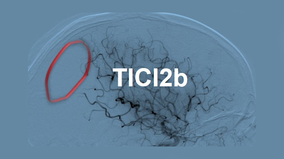 Reperfusion ohne Gabe von Urokinase