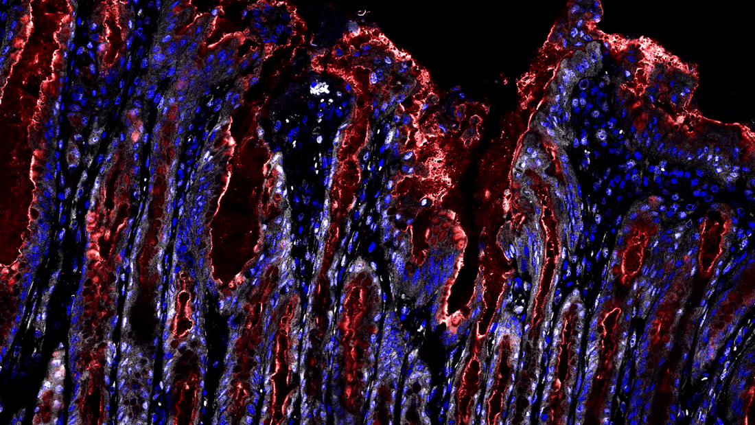 Magenschleimhaut nach Infektion mit Helicobacter pylori. Was als Reparaturreaktion beginnt, wird bei jahrelanger Infektion zum Dauerzustand und schafft die Voraussetzungen für Krebsvorstufen. Rot gefärbt sind die schleimbildenden Oberflächenzellen. Weiß dargestellt ist der aktive Signalweg, der das Gewebe in einen stark wachsenden Zustand versetzt. Im gesunden Magen ist dieser fast vollständig ausgeschaltet.