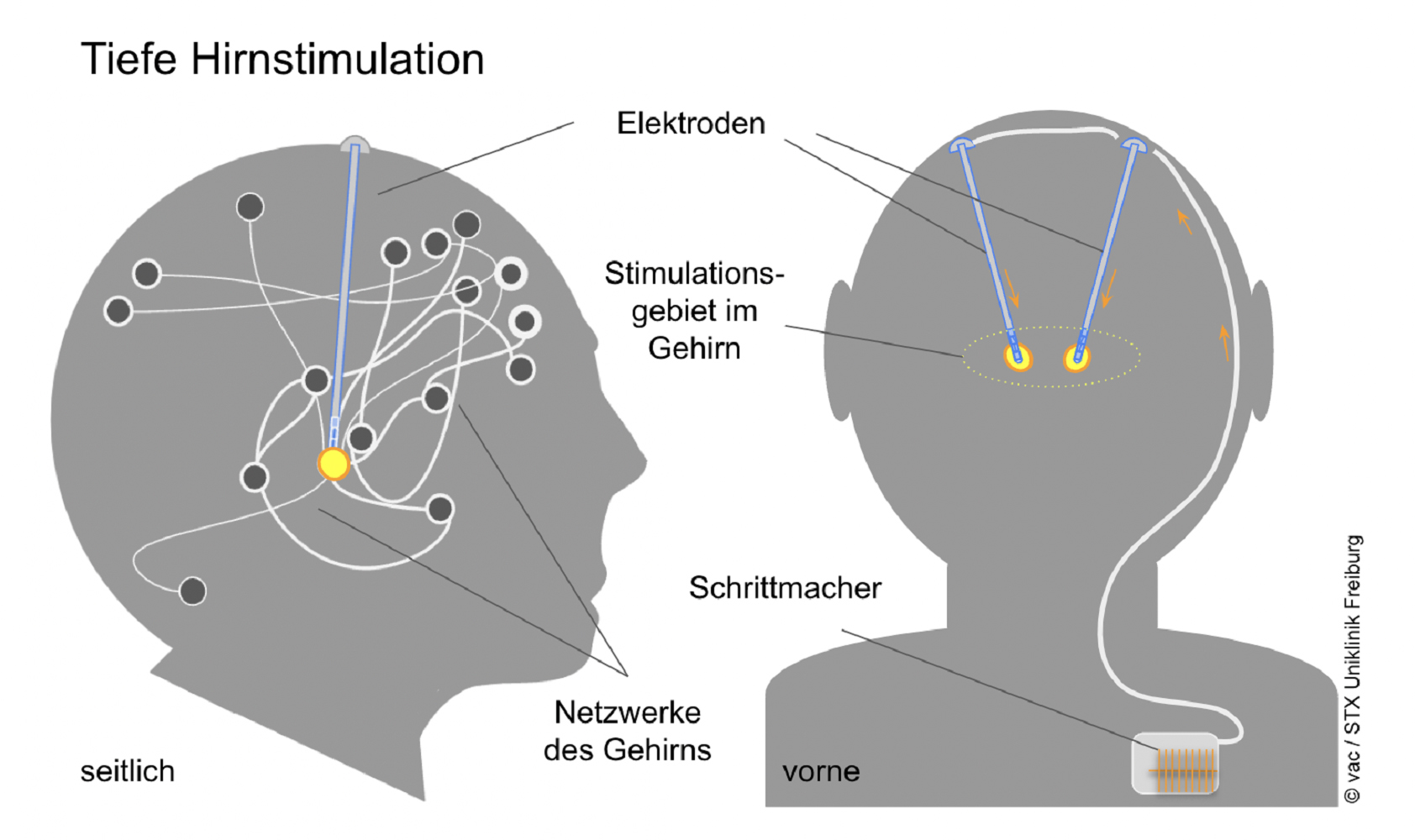 Tiefe Hirnstimulation