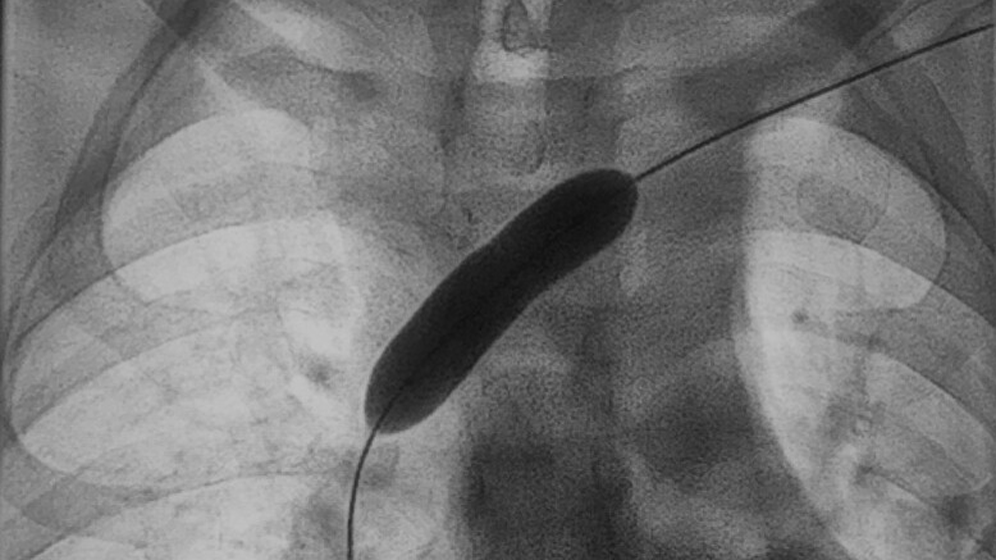 katheter-in-vena-subcvlavia-bildnachweis-thomas-vogl.gif Veneerkrankungen