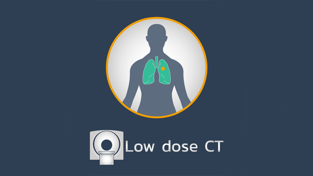 low_dose_CT_lung.jpg Symbolbild zur Low-Dose-CT