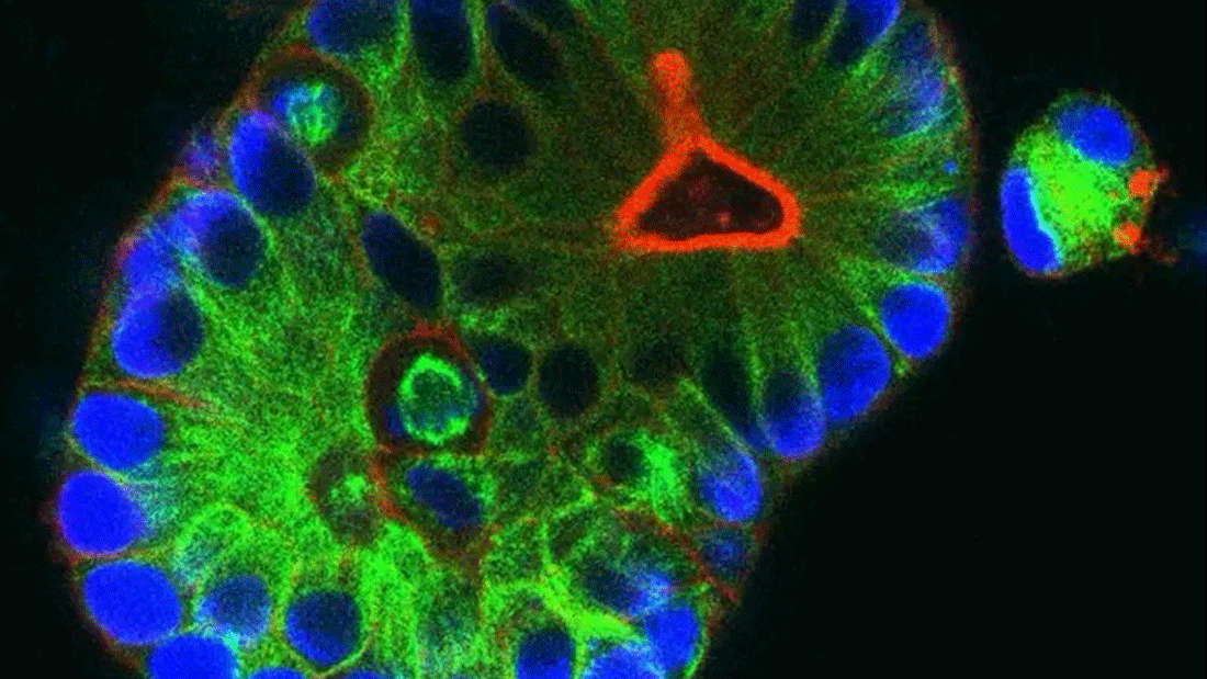 Mini-Tumore, sogenannte Organoide, werden aus Gewebe von Enddarmkrebs hergestellt. Sie dienen als Modell des Tumors, um neue Therapien zu testen.