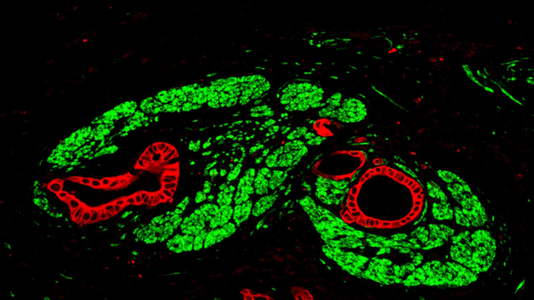 Bauchspeicheldrüsenkrebs in einer Immunofluoreszenz-Aufnahme: Die Tumorzellen sind rot, die von Tumorzellen befallenen Nerven grün markiert.