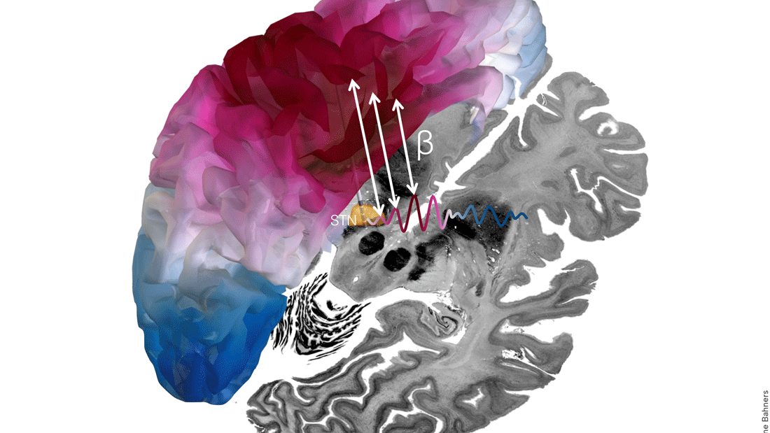 3D-Darstellung der Beta-Konnektivität zwischen dem Ort der Stimulation (Nucleus subthalamicus, STN) und der Hirnrinde sowie schematische Darstellung der Konnektivität über die Zeit. Im Hintergrund ist der Big Brain Atlas dargestellt.