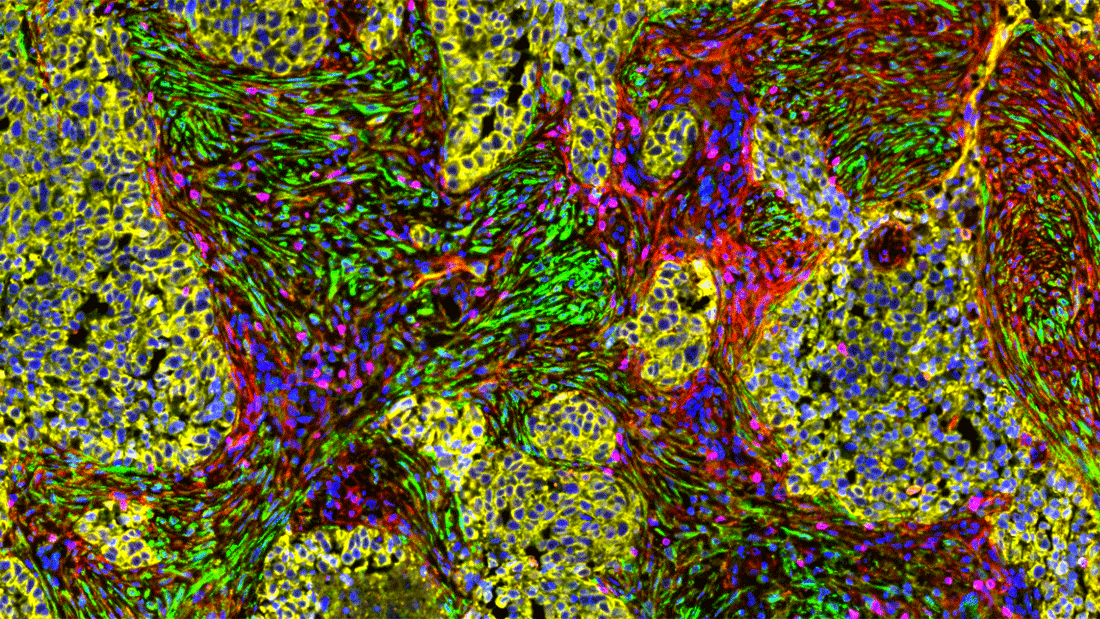 Die mikroskopische Aufnahme zeigt die Komplexität von Krebsgewebe. Tumorzellen sind gelb, Fibroblasten grün und Immunzellen pink markiert. Alle Zellen enthalten einen blau gefärbten Zellkern. In rot ist die Zielstruktur des bispezifischen Antikörpers markiert.
