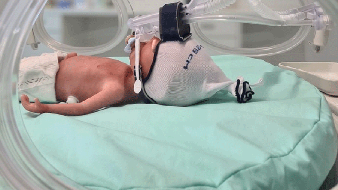 Das InhalPlus-Bypass-System wurde entwickelt, um inhalative Medikamente gezielt an Frühgeborene zu verabreichen, ohne die Atemunterstützung zu unterbrechen.